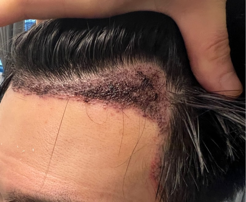 2. 수술후_1일_2.jpg