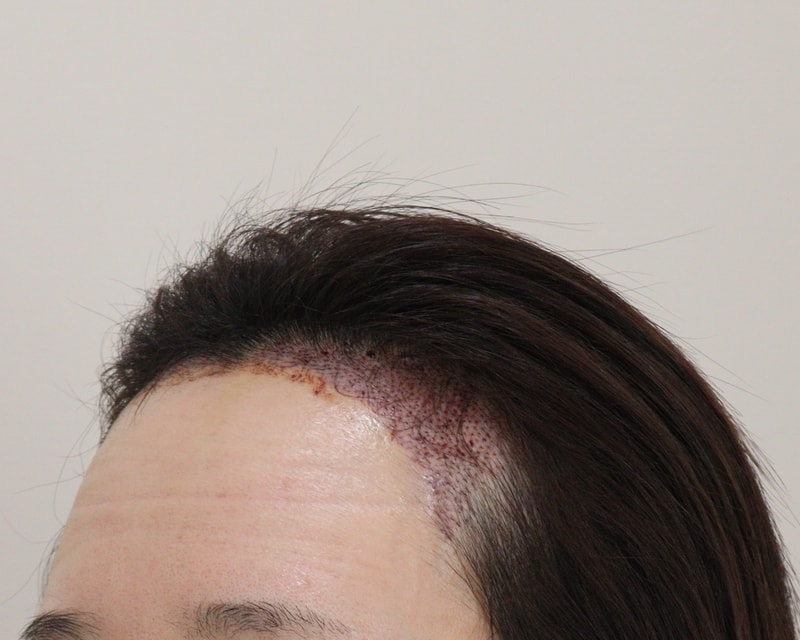 2. 수술후_1일_2.JPG