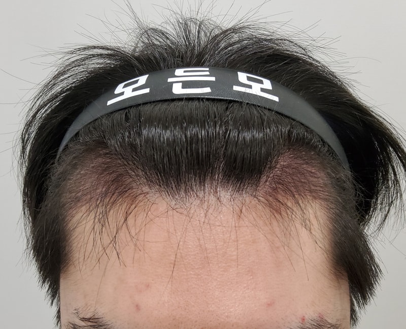 3. 수술후_3개월_1.jpg