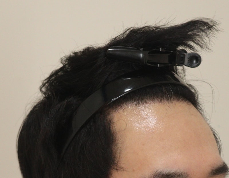 4. 수술후_6개월_4.JPG