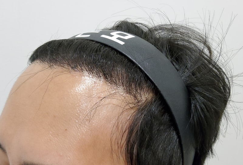 4. 수술후_6개월_2.jpg