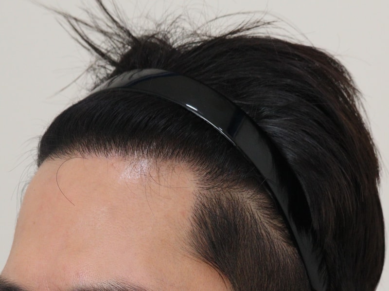 4. 수술후_1년_2.JPG