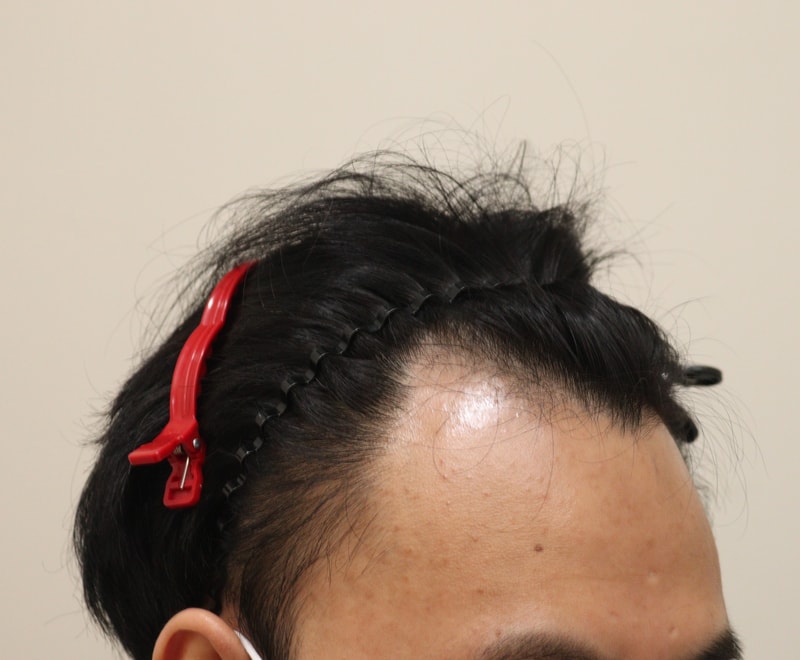 1. 수술전_3.JPG