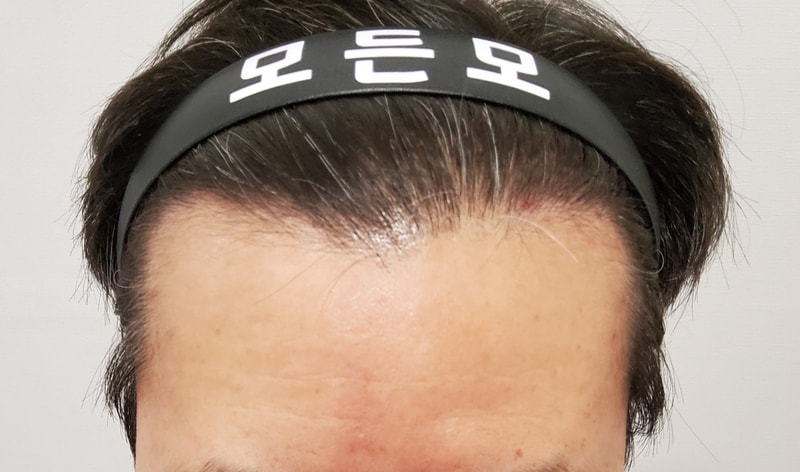 5. 수술후_1년_1.jpg
