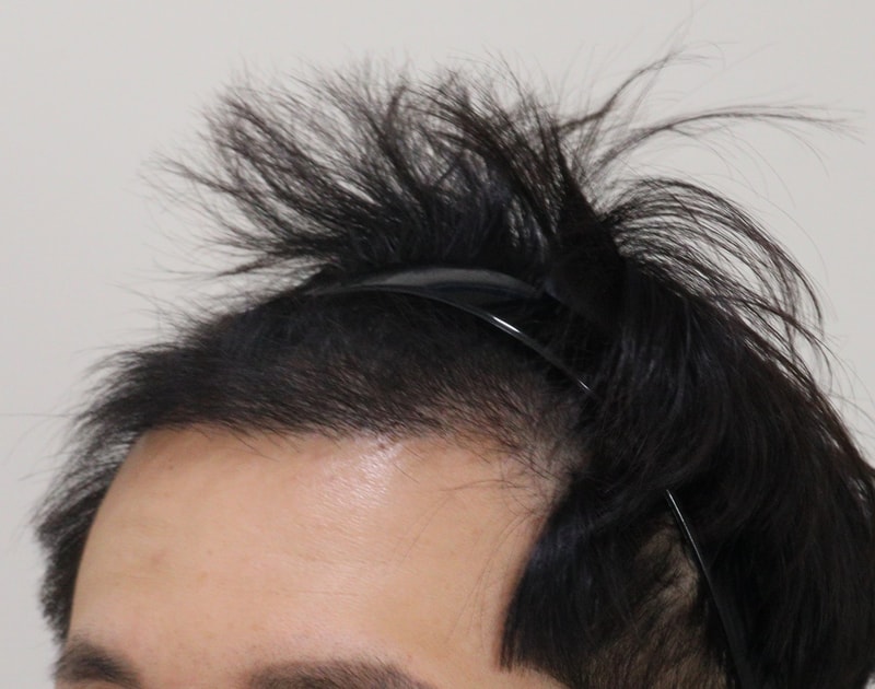 4. 수술후_5개월_4.JPG