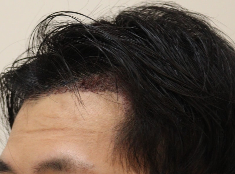 2. 수술후_1일_2.JPG