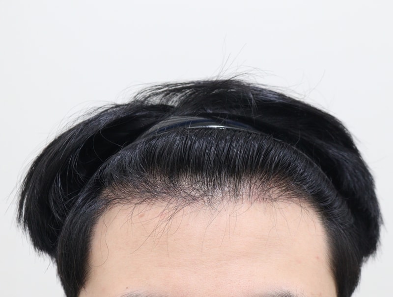 2. 수술후_7개월_1.JPG