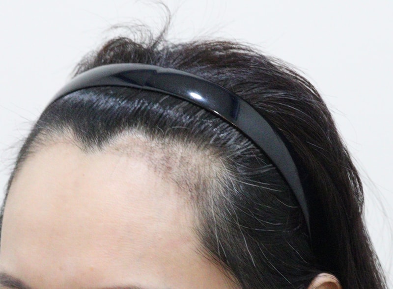 3. 수술후_3개월_2.JPG