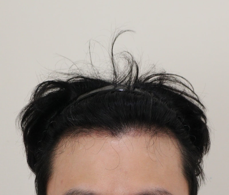 3. 수술후_3개월_1.JPG