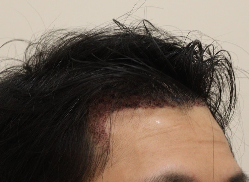 2. 수술후_1일_3.JPG