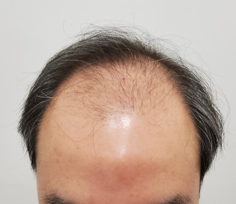 모발이식했습니다