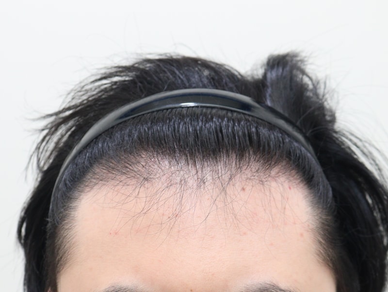 2. 수술후_6개월_1.JPG