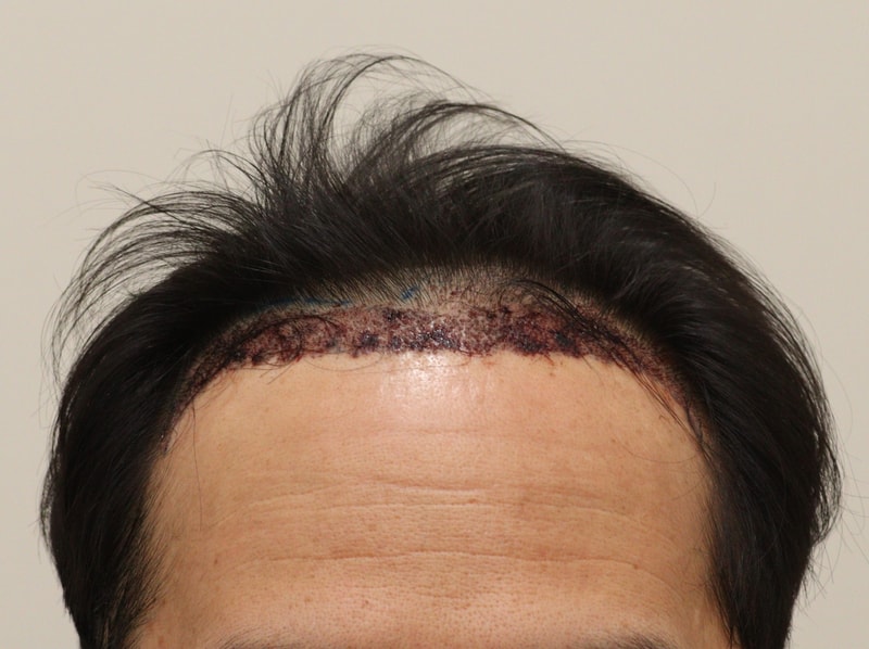 2. 수술후_1일차.JPG