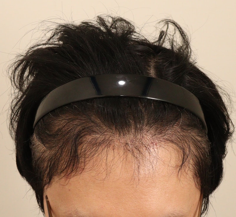 4. 수술후_6개월_1.JPG