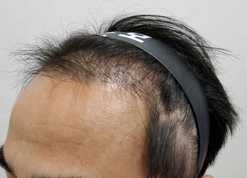 3. 수술후_3개월_2.jpg