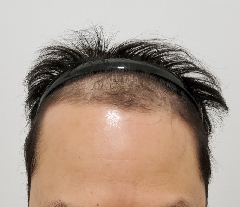 모발이식 하고왔습니다~