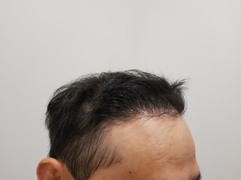 수술후_1년_2.jpg