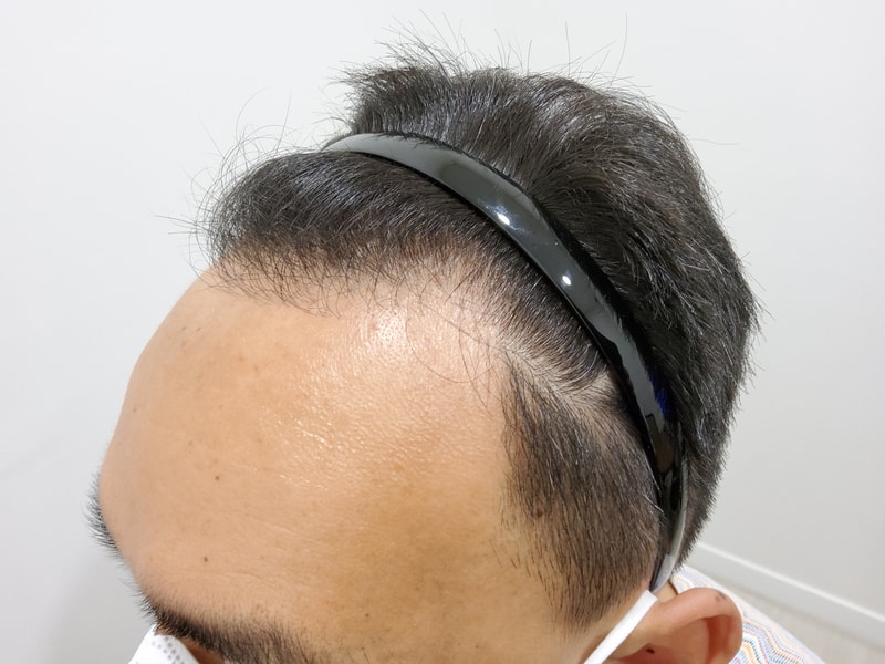 1. 수술전_2.jpg