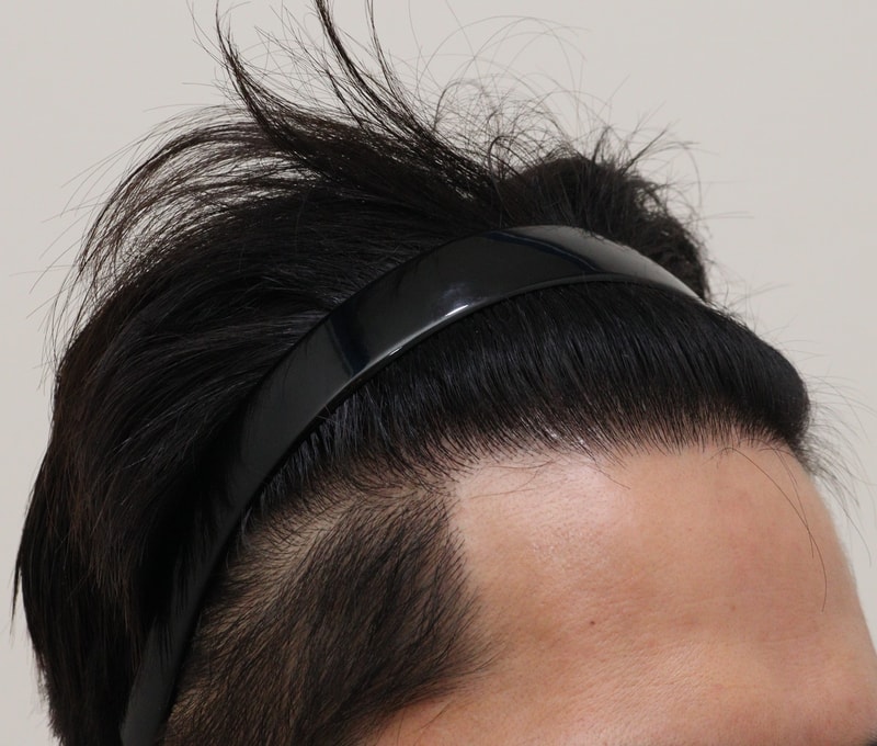 4. 수술후_1년_3.JPG