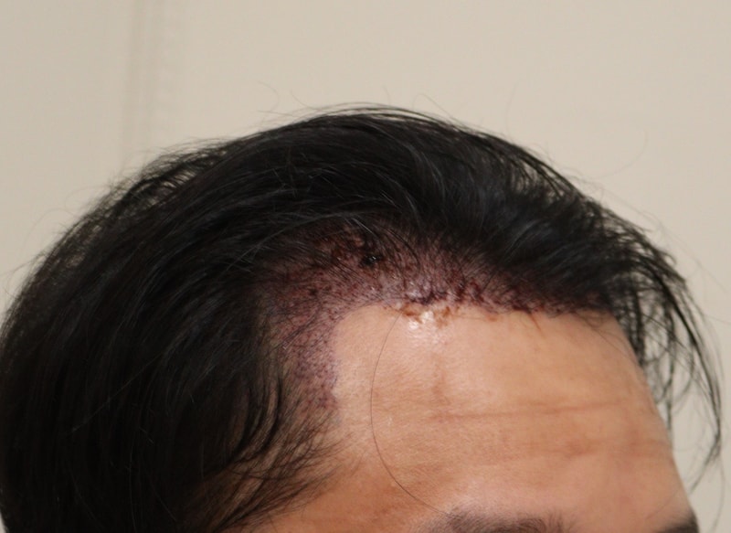 2. 수술후_1일_3.JPG