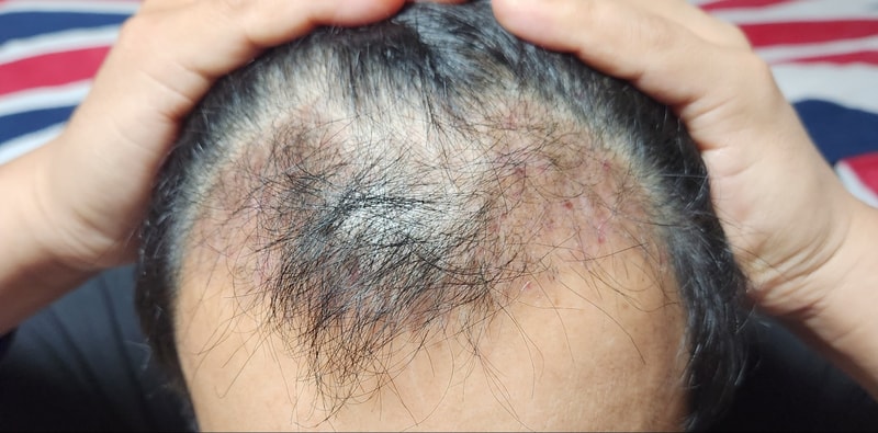 3. 수술후_3개월_셀카_1.jpg