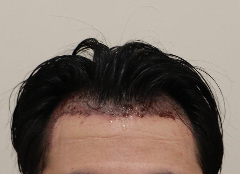 1. 수술후_1일_1.JPG