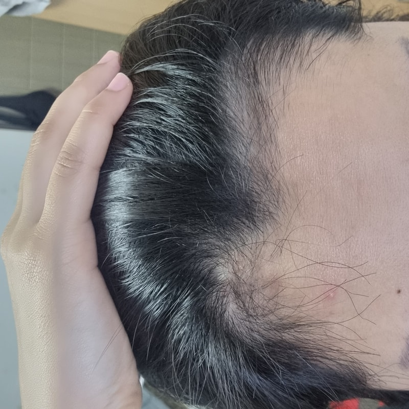 3. 수술후_3개월_셀카_1.jpg