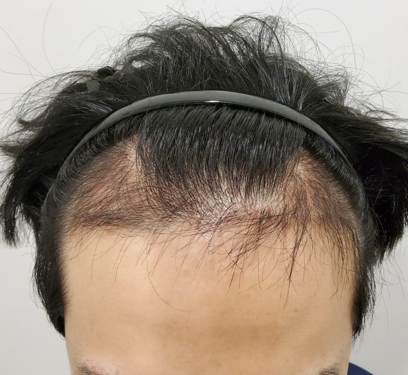 3. 수술후_3개월_1.jpg
