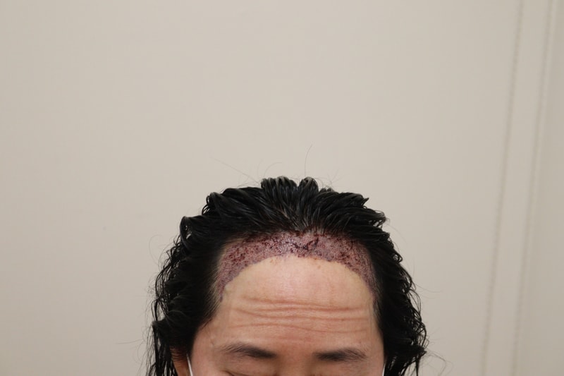 2. 수술후_1일_1.JPG