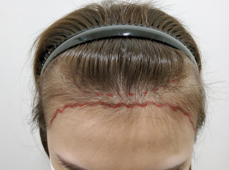 It's been a year of hair transplantation