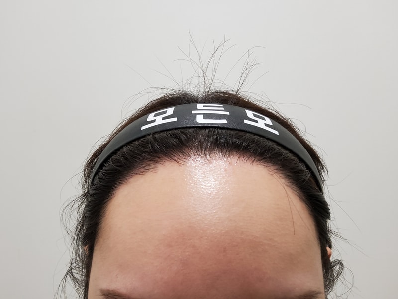 5. 수술후_1년후_1.jpg