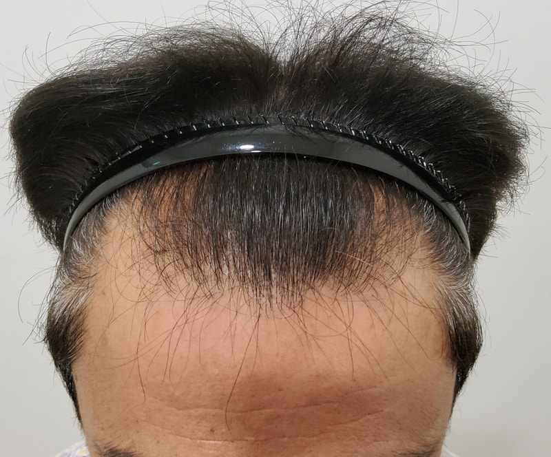 1. 수술전_2.jpg