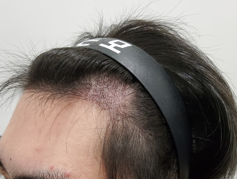 3. 수술후_3개월_2.jpg