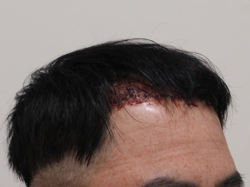 2. 수술후_1일_2.JPG