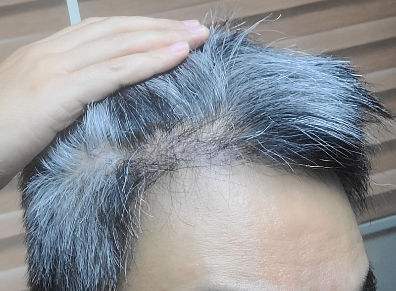 4. 수술후_6개월_셀카_2.jpg