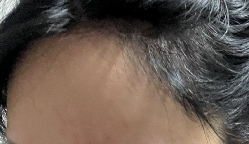 4. 수술후_6개월_셀카_3.jpeg