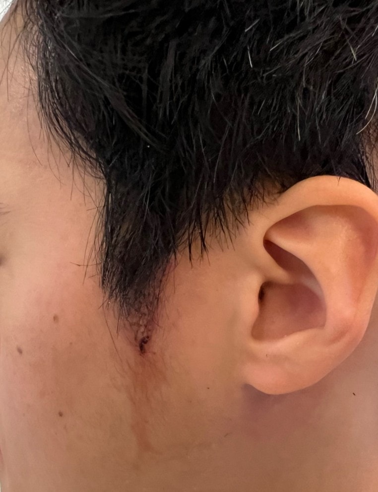 2. 수술후_1일_2.jpg