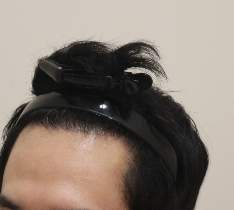 4. 수술후_6개월_3.JPG