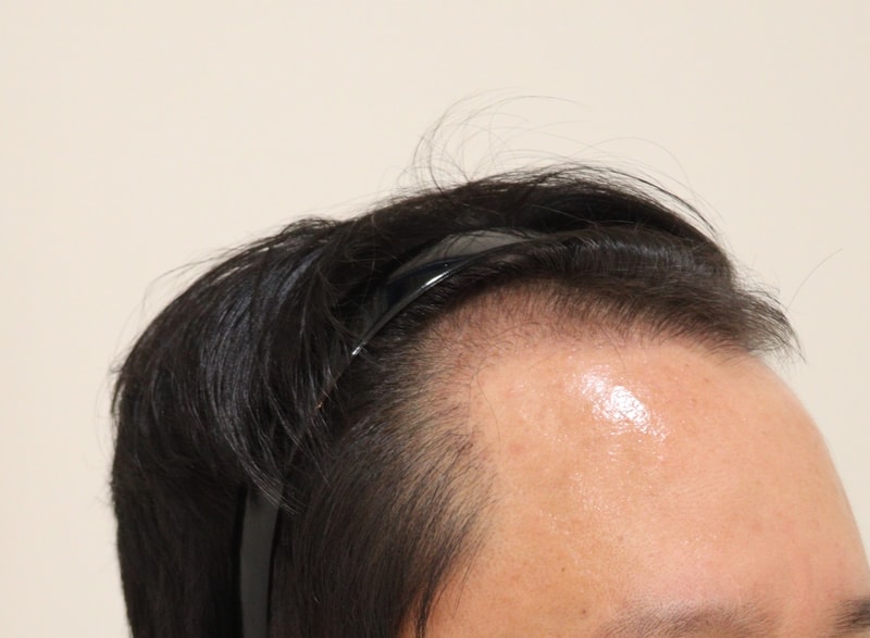 3. 수술후_3개월_3.JPG