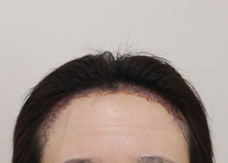 2. 수술후_1일_1.JPG