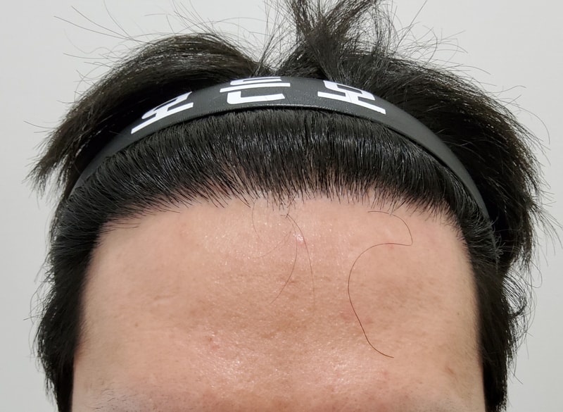 5. 수술후_1년_1.jpg