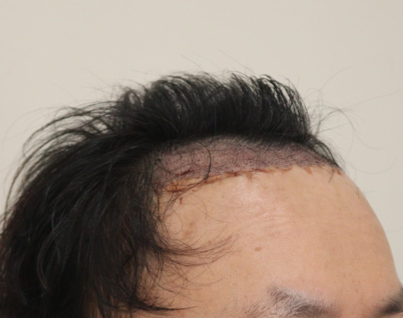 2. 수술후_1일_3.JPG