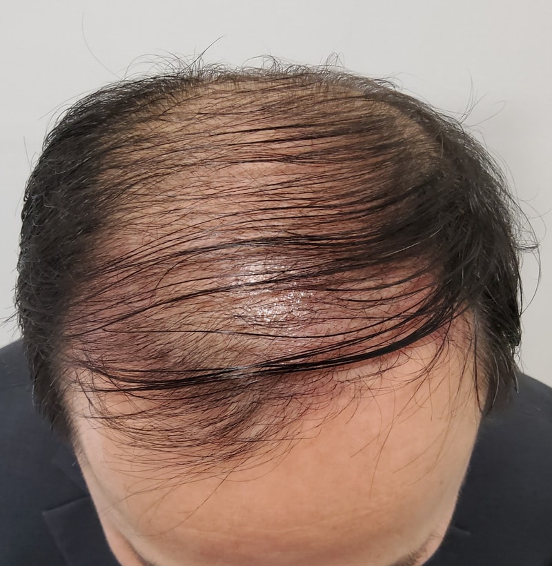 3. 수술후_3개월_2.jpg