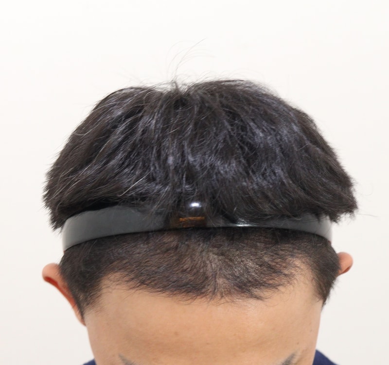 3. 수술후_5개월_1.JPG
