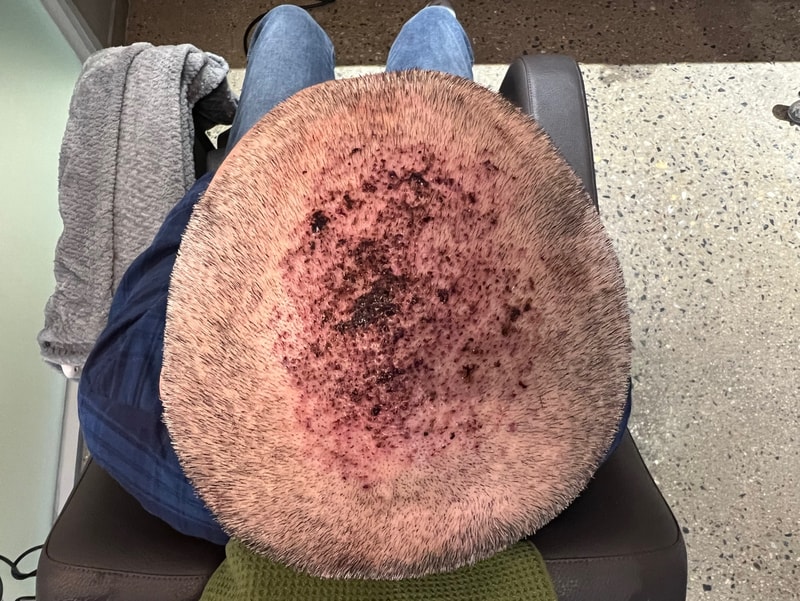 2. 수술후_1일.jpg