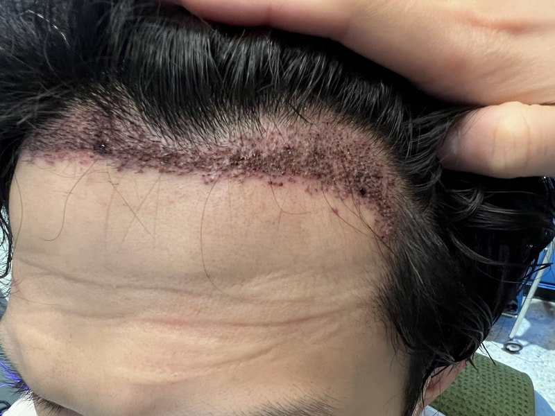 2. 수술후_1일_1.jpg