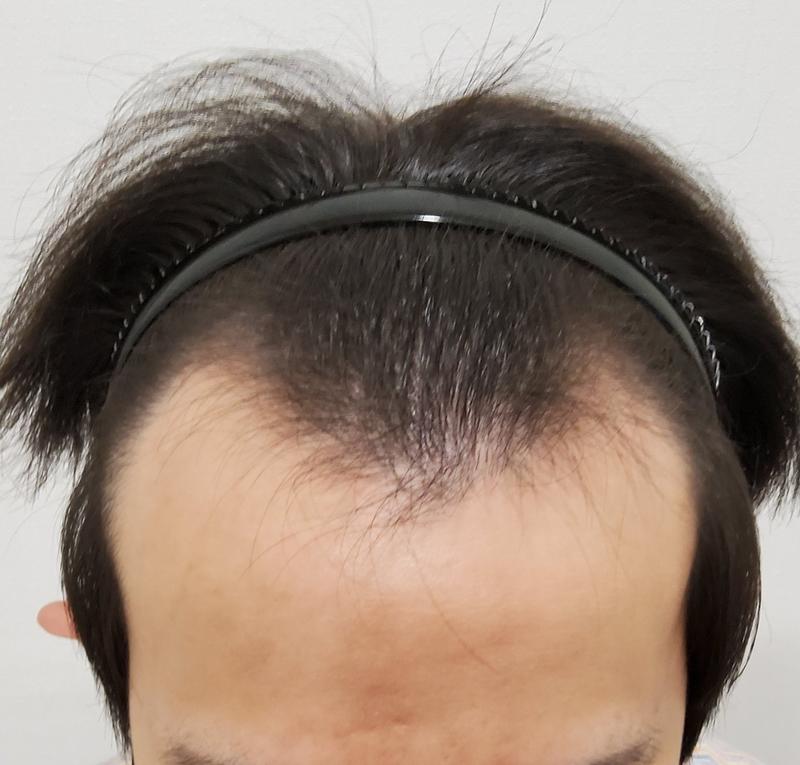 摆脱了脱发的烦恼