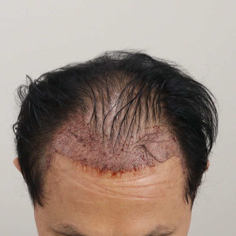 2. 수술후_1일.JPG