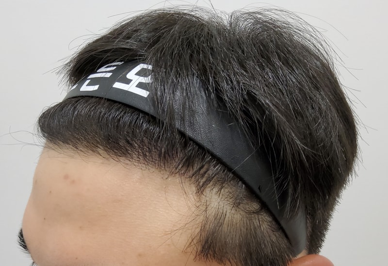 4. 수술후_1년_3.jpg