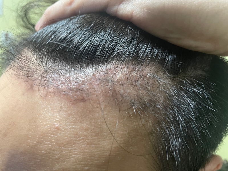 3. 수술후_3개월_셀카_2.jpg